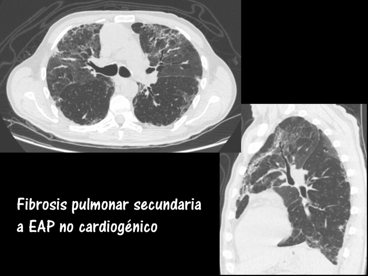 Fig. 42: Engrosamiento intersticial intralobulillar. TCAR planos axial y sagital (reconstrucción MPR), en paciente con datos de fibrosis pulmonar con antecedente reciente de EAP no cardiogénico.