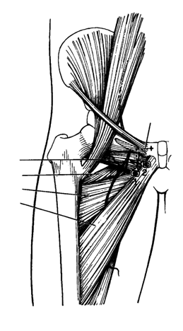 BLOQUEO DEL NERVIO OBTURADOR Anatomía Nervio mixto que se divide en dos ramas, una anterior y otra posterior.