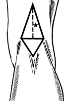 5 poplíteo tiene forma de rombo o diamante; los lados inferiores están formados por el músculo gemelo y los superiores están formados internamente por el músculo semimembranoso y externamente por el