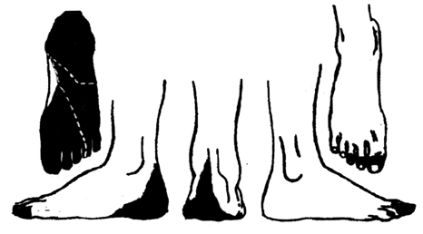 5 Fig. 5-23. Área de inervación cutánea del nervio sural o safeno externo. 1 2 3 Fig. 5-24. Distribución cutánea del nervio tibial posterior.
