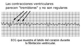 Asistolia: Es la ausencia de actividad eléctrica del corazón que se gráfica como una línea isoeléctrica.