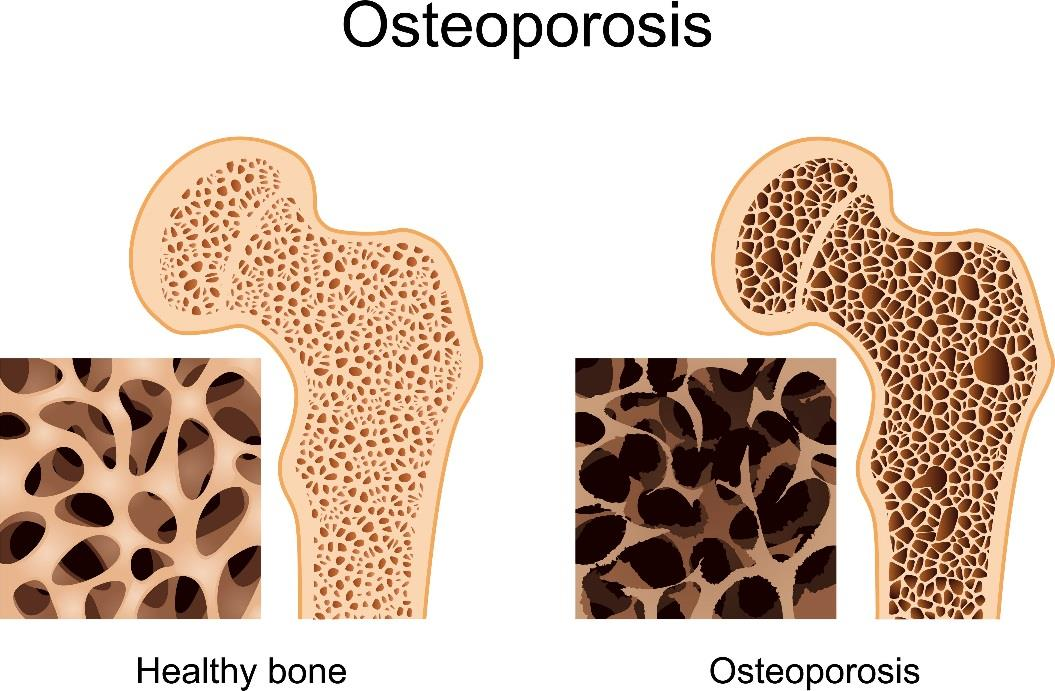 mantener e incrementar la densidad mineral ósea ya que intervienen con la diferenciación y la actividad de los osteoclastos.
