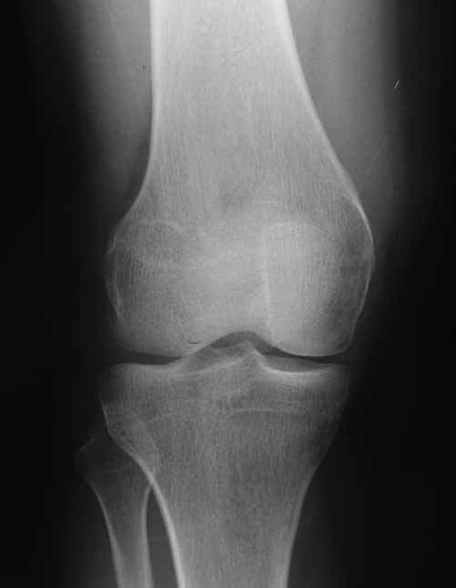 A Figura 3. A. Radiografía de rodilla de frente en las que se observa la desaparición de la exostosis a los cuatro años de seguimiento.. Radiografía de perfil.