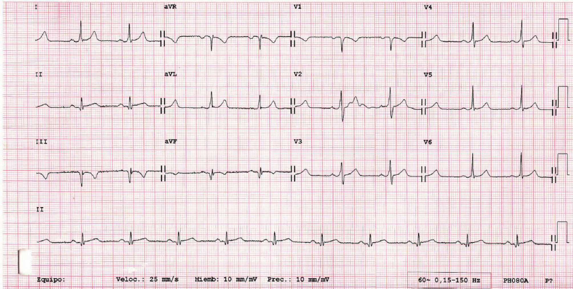 Cortés Ortiz A y col. Figura 1. Electrocardiograma de 12 derivaciones de la taquicardia de QRS ancho. Figura 2.