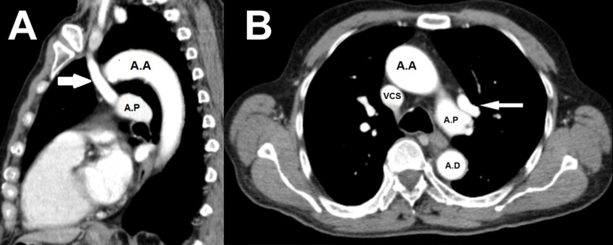 A Vena ácigos. A.A Aorta ascendente. A.P Arteria pulmonar principal. Fig. 6: TC de Tórax con contraste IV.