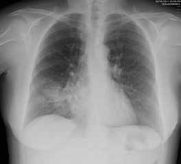 Igualmente, una lesión con densidad agua como, por ejemplo, un trozo de pulmón enfermo en contacto anatómico con el corazón, la aorta o el diafragma borrará sus bordes a lo largo de la zona de