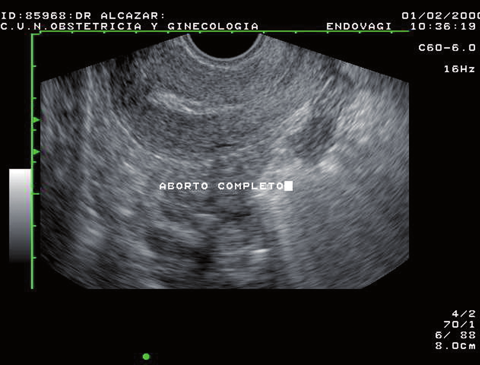 229 Figura 5. Aborto completo. Endometrio fino homogéneo compatible con útero vacío. Figura 6. Aborto incompleto.
