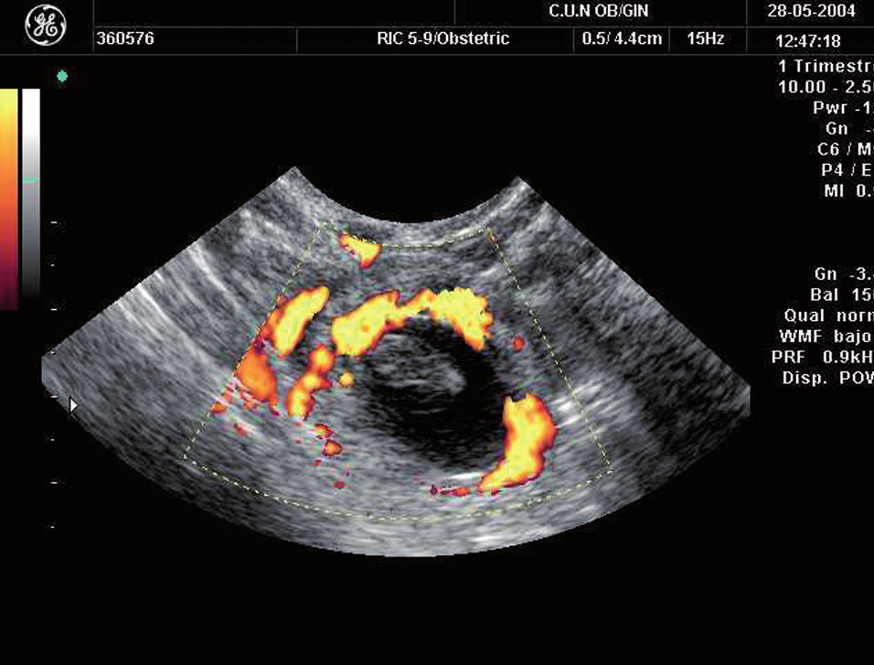 El hallazgo 100% específico de una gestación ectópica es la visualización del saco gestacional con el embrión o la vesícula vitelina (fig. 7).
