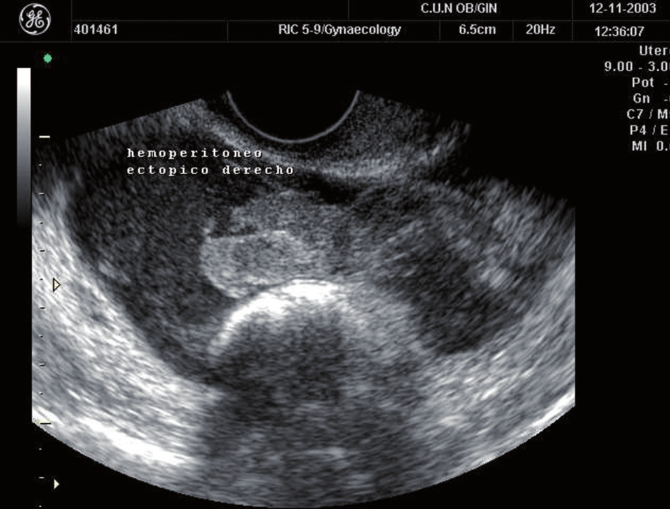 230 Figura 8. Embarazo ectópico. Puede observarse el saco gestacional en la trompa (anillo tubárico) y el útero vacío. Figura 9. Embarazo ectópico. Puede observarse una masa anexial con líquido alrededor compatible con hemoperitoneo.