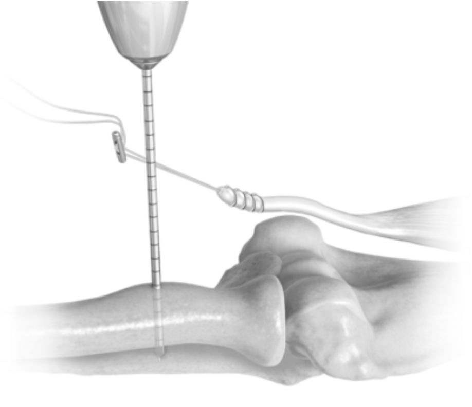 Rotura distal del tendón de la porción larga del bíceps braquial. Por qué está aumentado su incidencia? Cuándo se debe reparar? Figura 1.