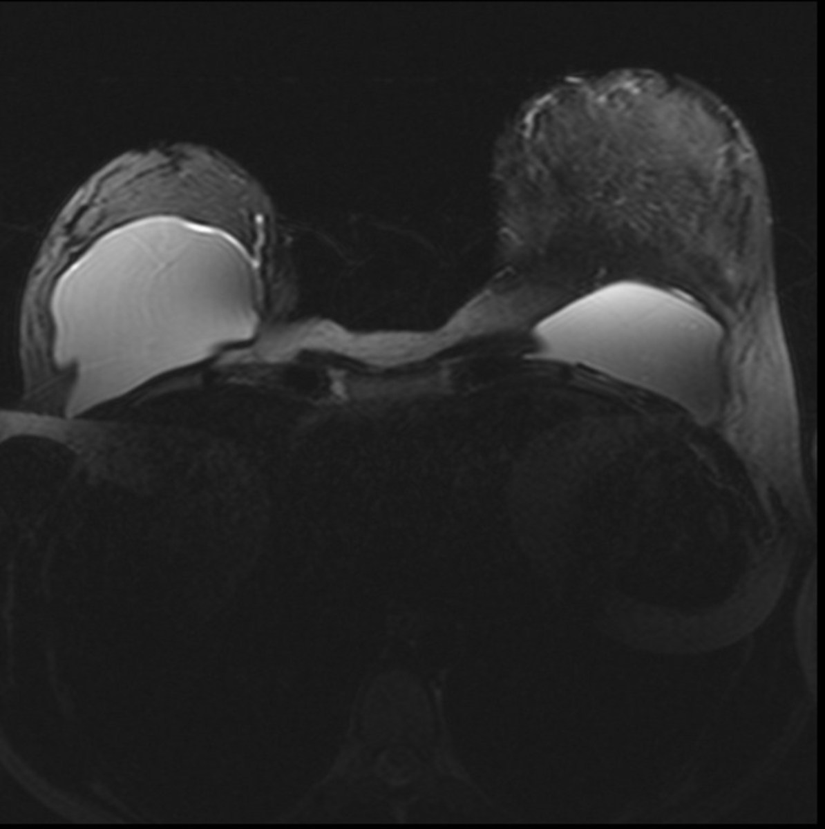 Fig. 1: Imagen axial de RM de mama. Secuencia axial TSE T2 con supresión grasa.