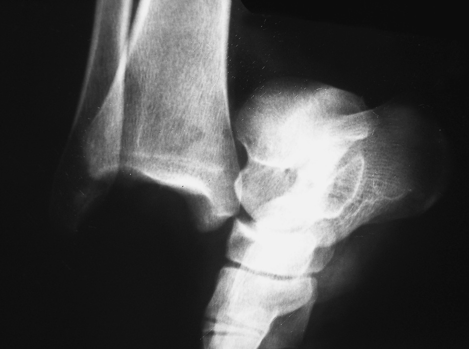 Caso clínico 1 Figura 1. Radiografía donde se muestra la luxación posteromedial con integridad de los extremos distales de la tibia y el peroné.