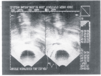 219 Fig. Imagen ultrasonográfica del quiste hidatídico en el lóbulo izquierdo del hígado de la paciente. los síntomas de dolor abdominal se trae a este centro para su valoración y mejor tratamiento.