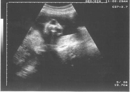Marcador genético: realizado el 29 de octubre de 2011. Ecografía: se informó, feto único, con ausencia de la bóveda craneal y el encéfalo (fig.