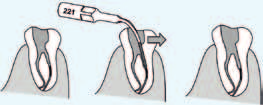 Eliminación de calcificaciones en el tercio coronal del sistema de