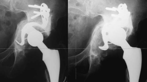 Los autores también describen la fractura de uno de los tornillos ilíacos en 2 casos a los 9 años de la operación, sin relevancia clínica ni signos radiográficos de falla.
