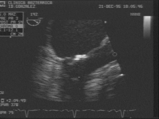 A- Ecocardiograma transesofágico vista medioesofágica 4 cámaras ( 0 ) se visualiza el compromiso mitral reumático por engrosamiento de los bordes así como del cuerpo de ambas valvas, obsérvese