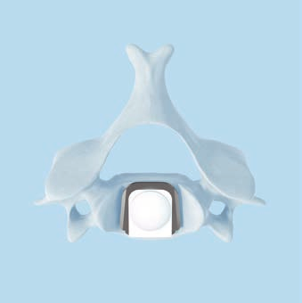 IMPLANTES Dimensiones Para garantizar una cobertura óptima de los platillos vertebrales, las prótesis se fabrican en seis tamaños de superficie: M