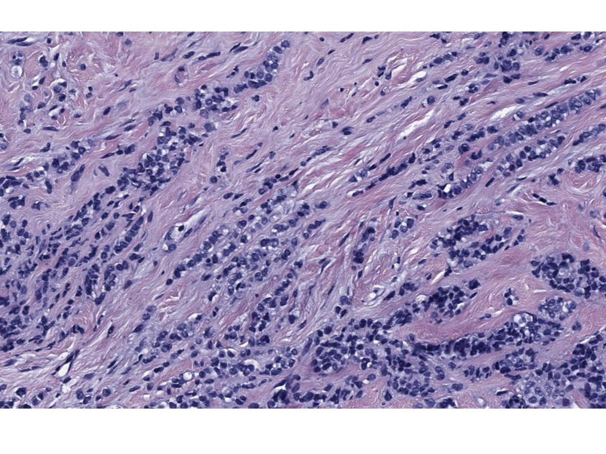 Fig. 6: Cilindro- biopsia de tejido mamario con una neoplasia de células epiteliales que se disponen en nidos y regueros sin formación de luces,