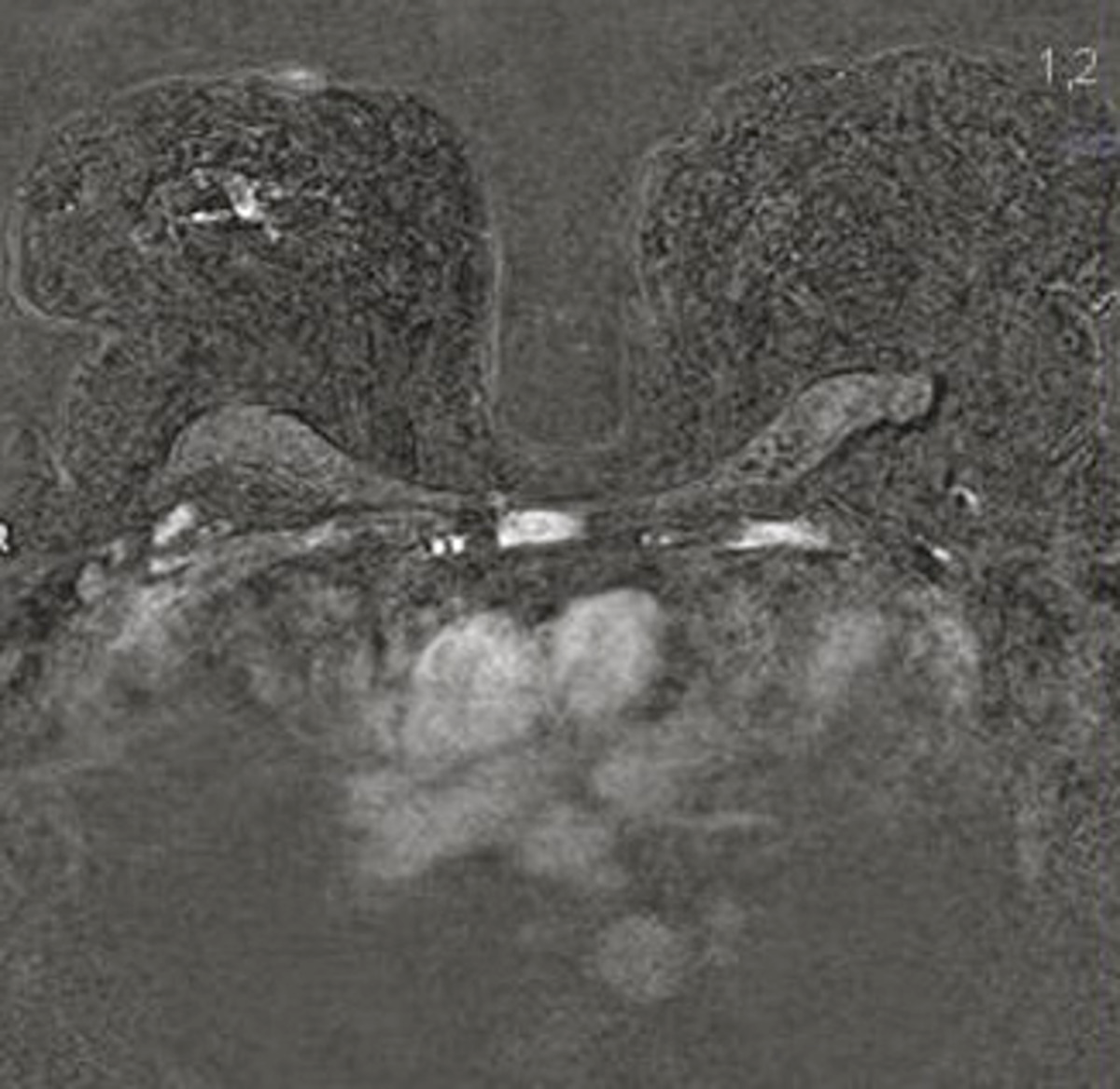 Fig. 7: La imagen presentada muestra leve área de captación patológica en mama derecha sin masa asociada, casi inapreciable, que demuestra