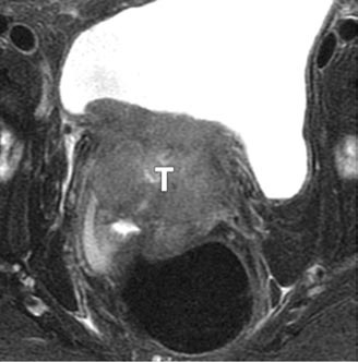 La lesión infiltra la pared vesical posterior, la vagina y la uretra (asterisco en C).