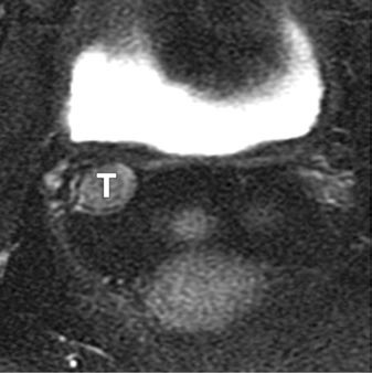 A B Fig. 9. Mujer de 67 años con recidiva de un carcinoma del cuello uterino tras radioterapia.