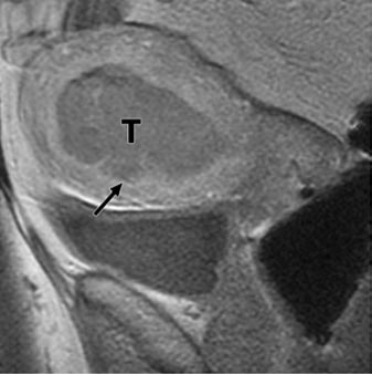 Nótese la interrupción de la zona de unión (flechas en A). El tumor invade menos del 50% del miometrio (flechas en B), lo que se observa mejor en T1.