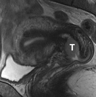 A B Fig. 5. Mujer de 47 años con carcinoma cervical estadio IIB.