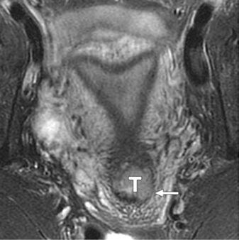 Existe infiltración del estroma del cuello uterino en la parte izquierda, lo que se aprecia como una interrupción focal del anillo hipointenso (flecha en B).