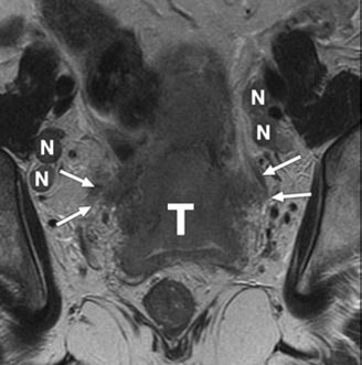 Papel de la resonancia magnética en la valoración de adenopatías en tumores ginecológicos La existencia de adenopatías metastásicas en pacientes con carcinoma de endometrio o cérvix ensombrece el