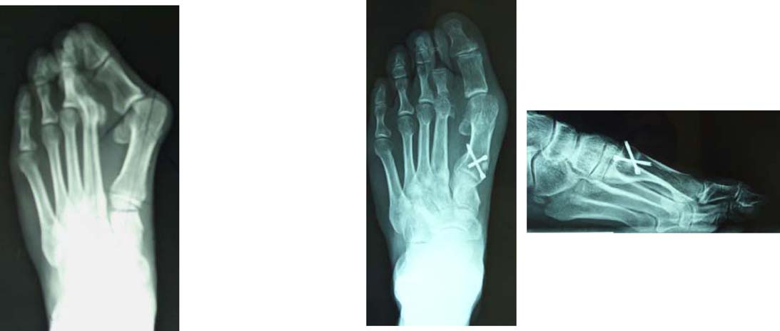 40º 18º E A B 22º C D 10º Figura 3 A) Varón de 41años, aspecto del pie izquierdo con pronación del primer dedo y segundo dedo supraductus. B) Estudio radiológico antes de la cirugía.