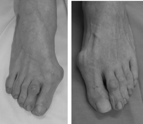 F) Control a los 2 años. Escala de la American Orthopaedic Foot and Ankle Society para el pie derecho: 90 puntos; para el pie izquierdo: 72 puntos.