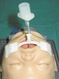 Durante el mantenimiento de la intubación y VM 1. Obstrucción del tubo endotraqueal (taponamiento o acodamiento). 2. Extubación accidental. 3. Intubación selectiva. 4. Neumotórax. 5.