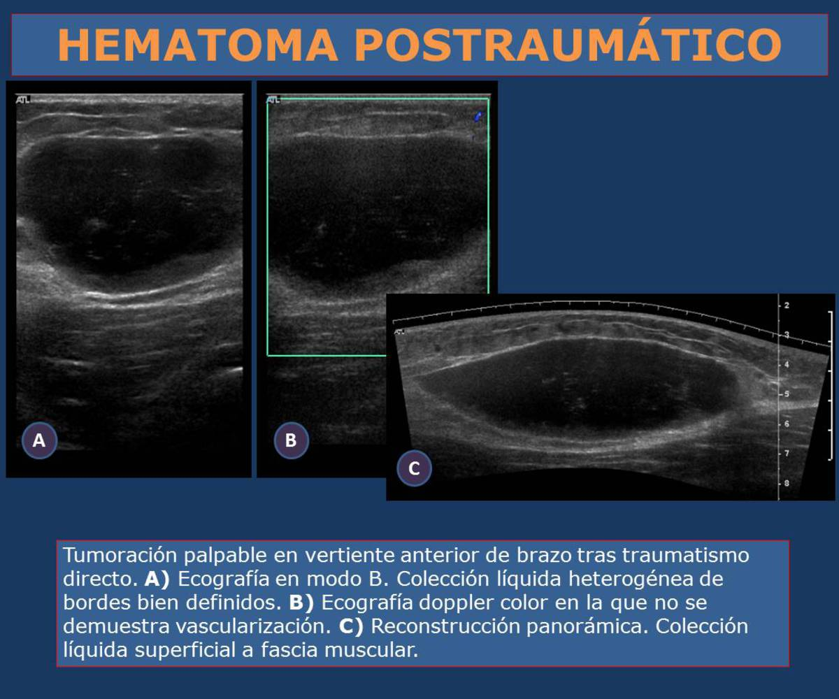 Fig. 7: HEMATOMA POSTRAUMÁTICO - COLECCIONES LINFOSEROSAS (SEROMA DE MOREL-LAVALLÉ): Colección subcutánea serosa o serohemática localizada por fuera de la aponeurosis muscular.