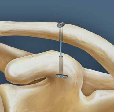 Estabilización artroscópica de la luxación aguda de la articulación acromioclavicular