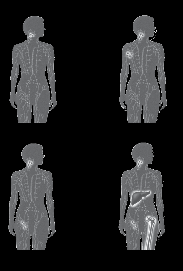 Etapas del linfoma Etapa I El linfoma se encuentra en una sola región de los ganglios linfáticos o en un solo órgano. Etapa II Dos o más regiones de ganglios linfáticos en el mismo lado del diafragma.