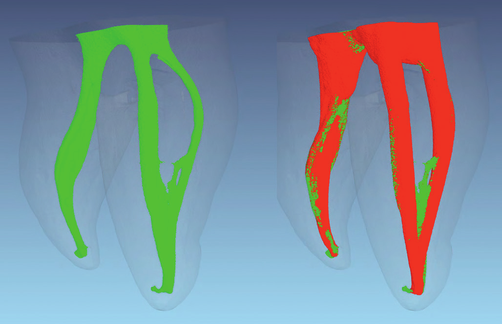 Micro CT 3D : Morfología de conductos antes de la instrumentación (verde); paredes de conductos