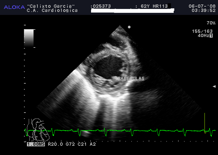 VI Miocardio no compactado Miocardio compactado Figura 5: Vista transversal del VI, donde se evidencia uno de los criterios ecocardiográficos de más valor en el diagnóstico de miocardiopatía