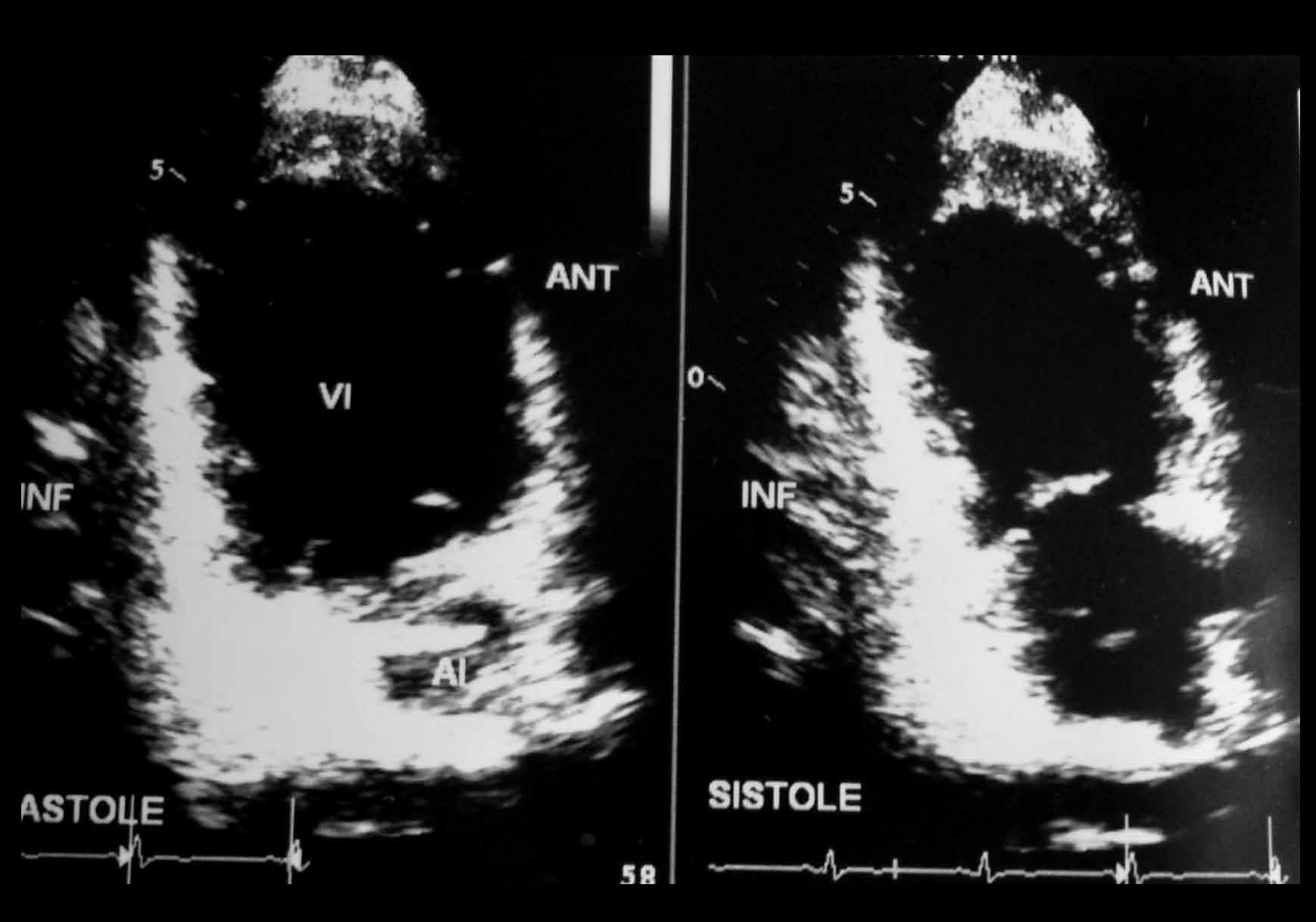 Figura 2. Radiografía: crecimiento moderado concéntrico del ventrículo izquierdo.