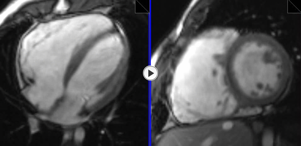 Referencias: A. CAPELASTEGUI ALBER; Osatek, Hospital de Galdakao, Galdakao, SPAIN Fig. 5: Miocardiopatía Arritmogénica Biventricular. Caso 1: cine 4C (izquierda) y EC (derecha).