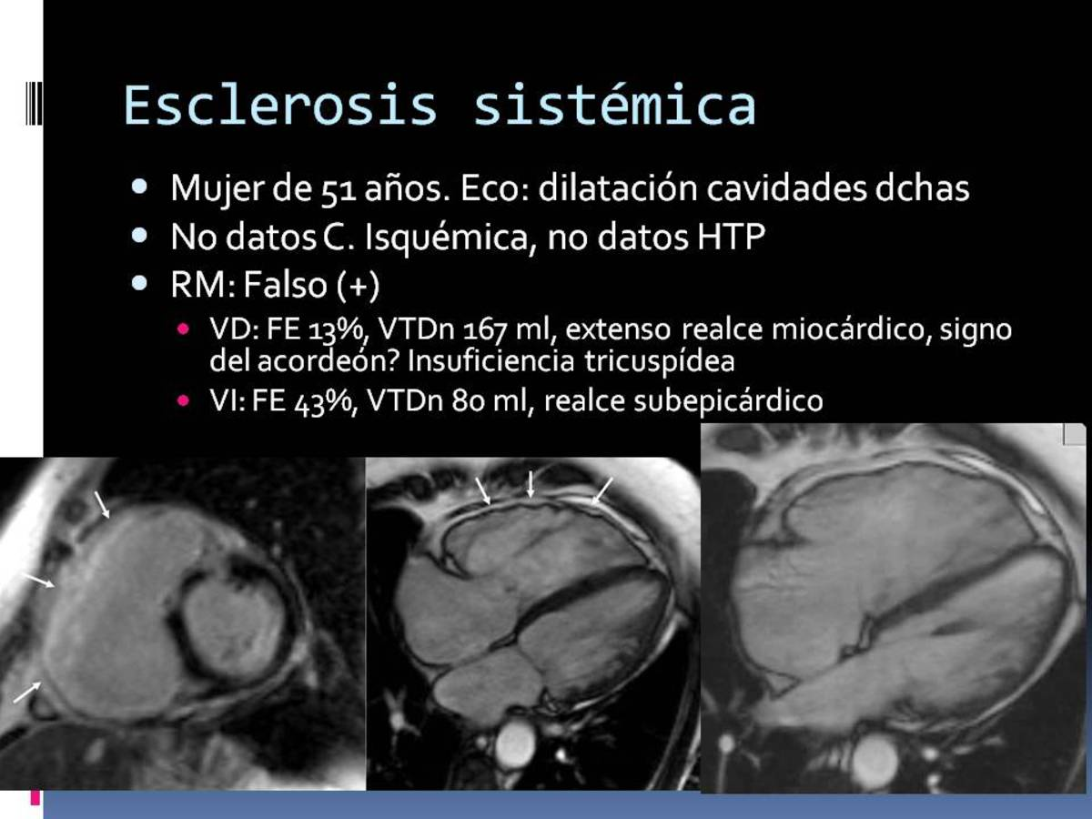 Fig. 11: Afectación del VD en esclerosis sistémica, que plantea diagnóstico diferencial por imagen con