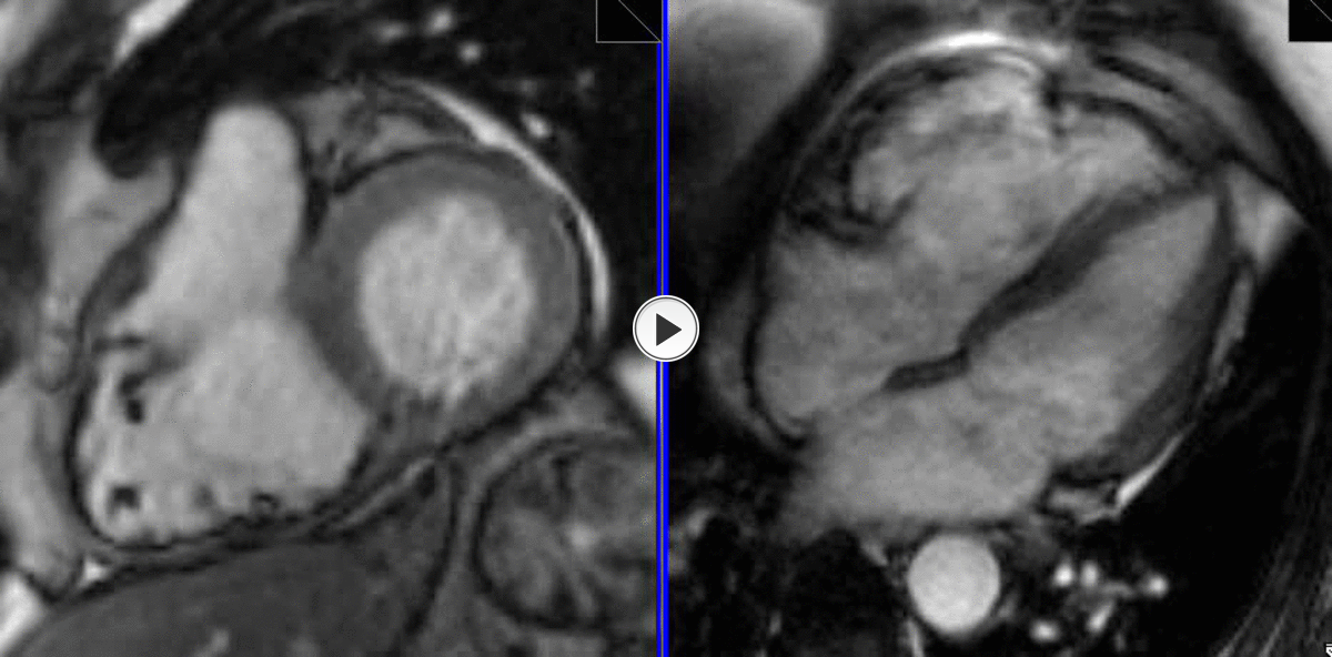 Fig. 7: Aneurisma en la pared libre del VD en un paciente de 79 sin otros criterios de DAVD: cine EC (izquierda) y 4C (derecha). Referencias: A.