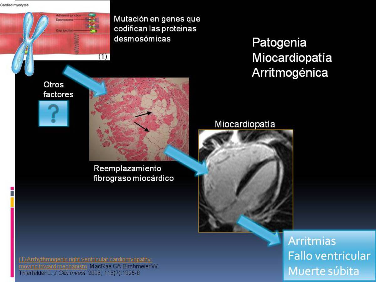 Objetivos La Displasia Arritmogénica del VD (DAVD), también denominada Miocardiopatía Arritmogénica (MCA), es una cardiomiopatía genética caracterizada por un reemplazamiento fibrograso miocárdico