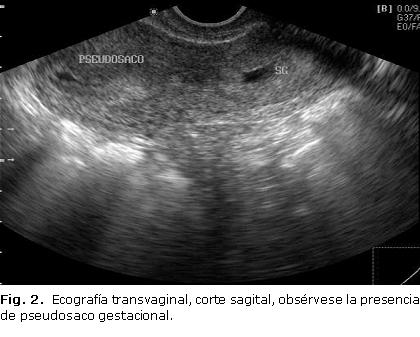 11/02/2010: misoprostol vaginal y desaparecen las señales vasculares del cérvix. 12/02/2010: misoprostol 400 mcg vaginal. 13/02/2010: dilatación cervical.
