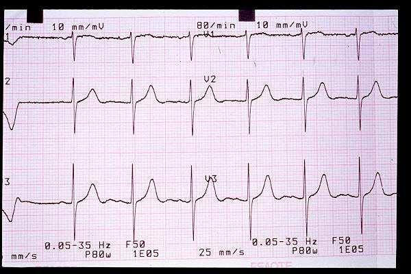 diagnóstico de IC ECG: FA, QRS ancho, ondas Q.
