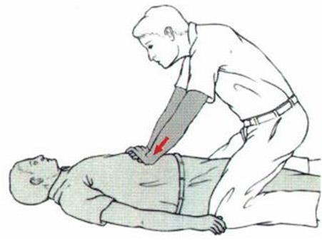C.Paciente inconsciente: se realiza la misma maniobra (Maniobra de Heimlich) pero con el paciente en el suelo.