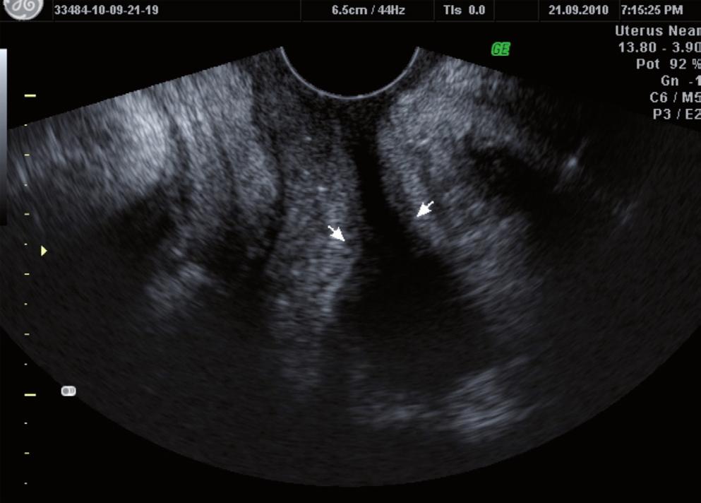 MÓDULO 3 Artículos Uro Con la ecografía transperineal, en el mismo corte medio sagital, se puede estudiar si durante el esfuerzo se abren el cuello vesical y la uretra, y si éstos permanecen abiertos