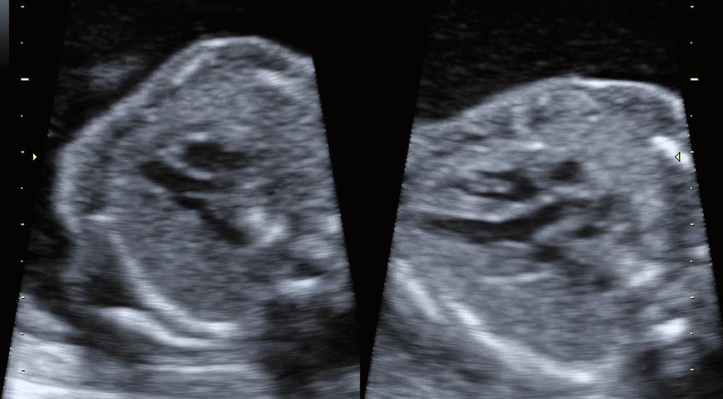 válvula mitral (calipers). Derecha: misma imagen con Doppler color en la que se objetiva la salida del flujo por la aorta con relleno homogéneo y contorno bien definido, liso y regular.