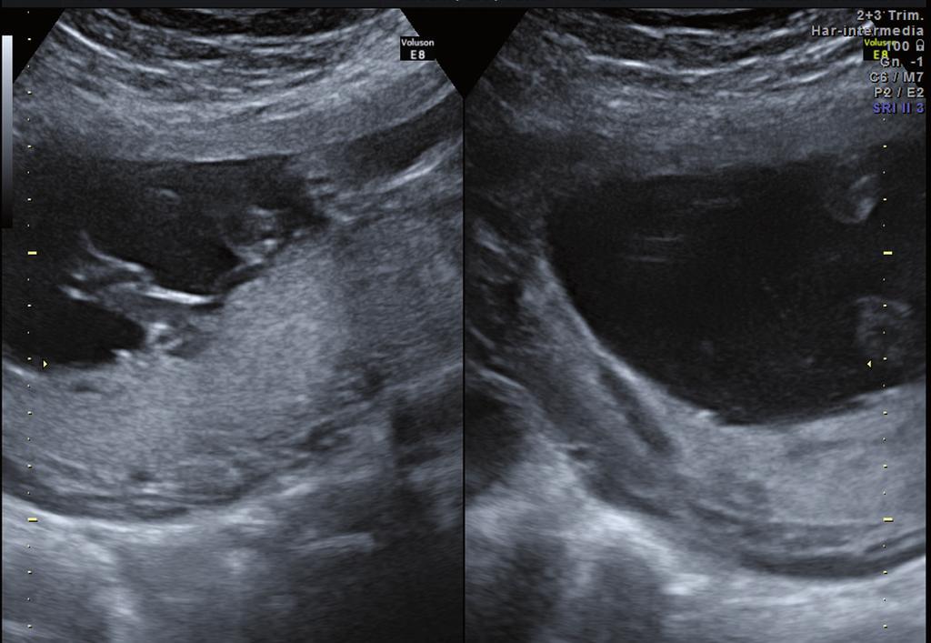 7. Anatomía fetal normal 169 P Figura 7-29. Izquierda: inserción placentaria del cordón umbilical. En ocasiones, el Doppler color es de suma utilidad para el diagnóstico preciso.