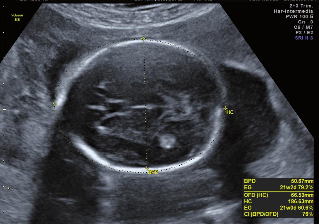7. Anatomía fetal normal 145 3 3 2 1 1 P Figura 7-1. Tálamos (1) aparentemente fusionados con forma de punta de flecha hacia el occipucio.
